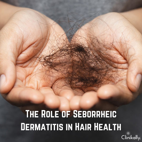 The Role of Seborrheic Dermatitis in Hair Health
