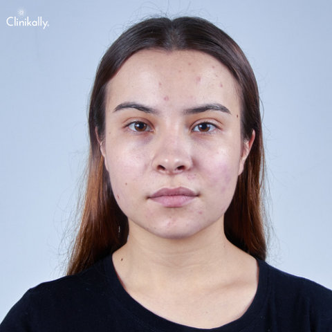 Does Oily Skin Age Better?