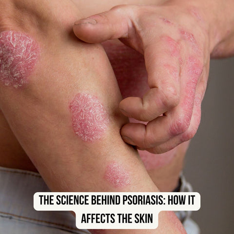 The Science Behind Psoriasis: How It Affects the Skin