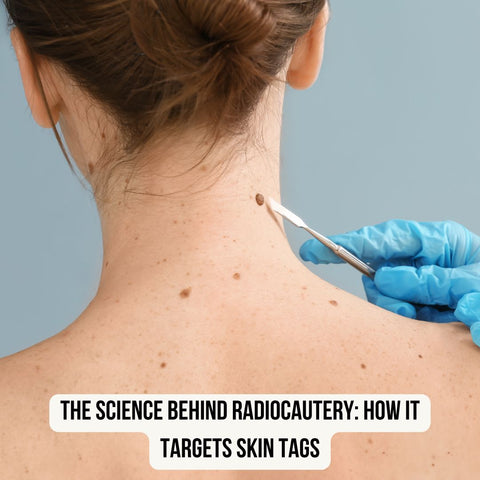 The Science Behind Radiocautery: How It Targets Skin Tags