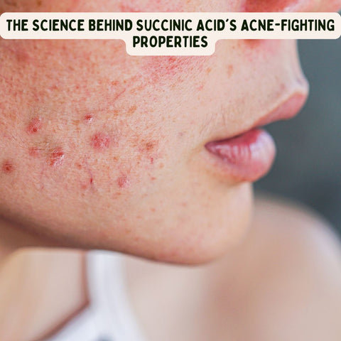 The Science Behind Succinic Acid's Acne-Fighting Properties