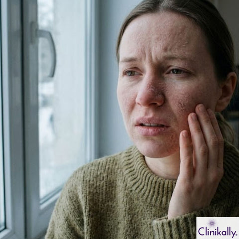 Woman with dry, flaky winter skin