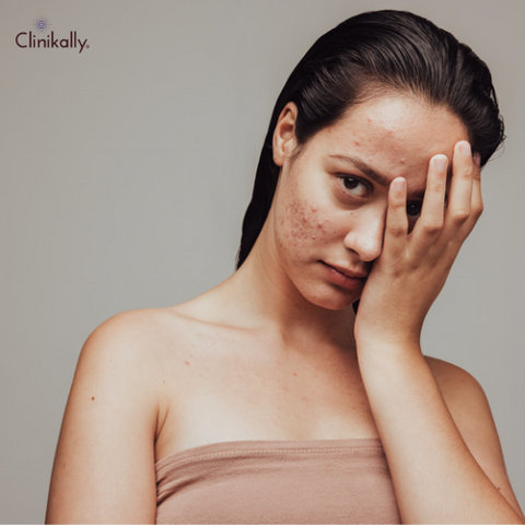 Hydrocolloid Patches The Skin Care Secret You Need to Know About