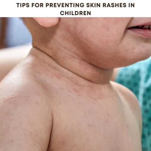 Tips for Preventing Skin Rashes in Children