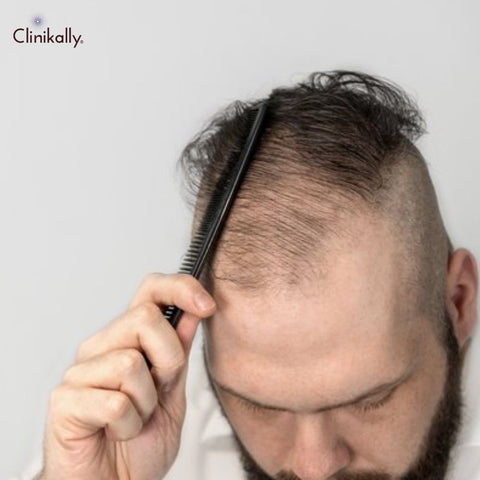 Tips for incorporating topical finasteride into your daily hair care routine