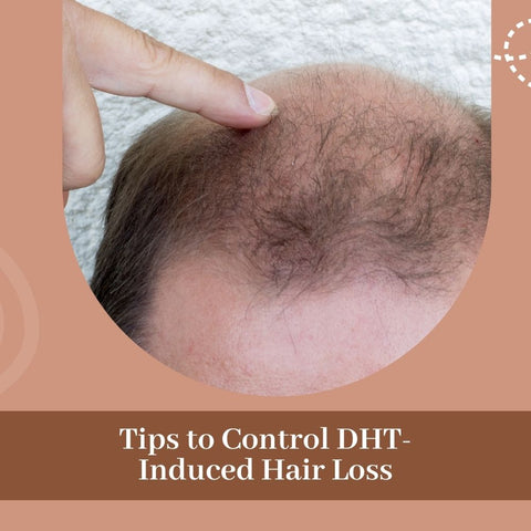 Tips to Control DHT-Induced Hair Loss