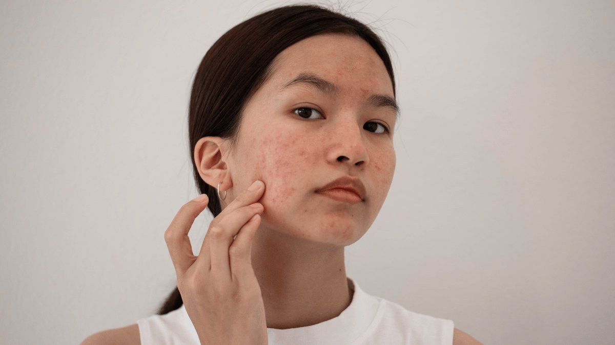 The Truth About Using Toothpaste for Acne: Is It Really a Good Idea?