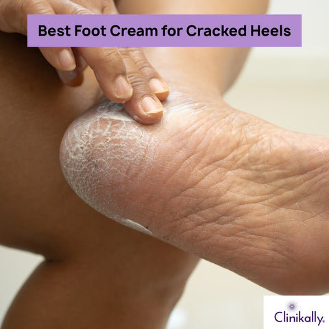 Top 5 Foot Creams for Cracked Heels
