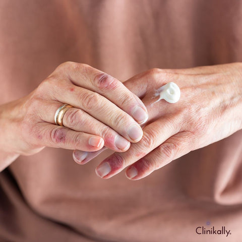 Topical steroids for itchy skin relief