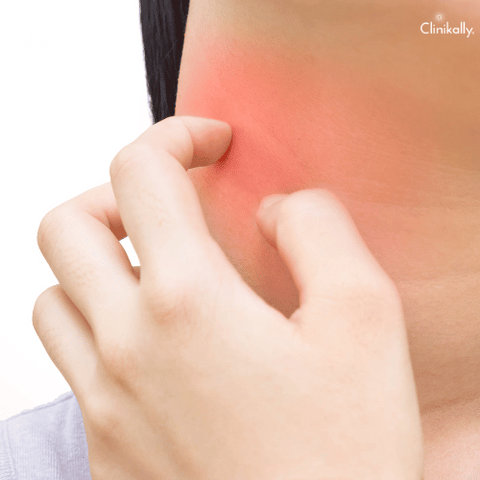 Traveling skin rash