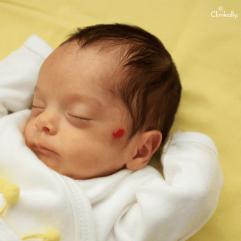 Infantile Hemangioma