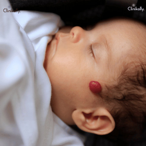 Infantile Hemangioma (Strawberry Birthmark)