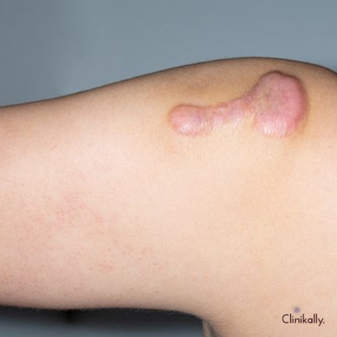 atrophic scars