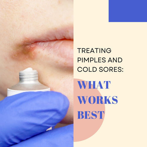 Treating Pimples and Cold Sores: What Works Best