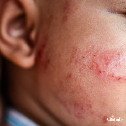 How to treat baby acne scars