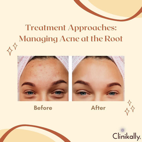 Treatment Approaches: Managing Acne at the Root