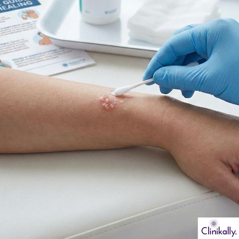 Doctor applying treatment to skin vesicle with cotton swab