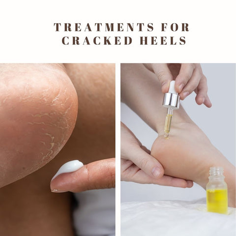 Treatments for cracked heels