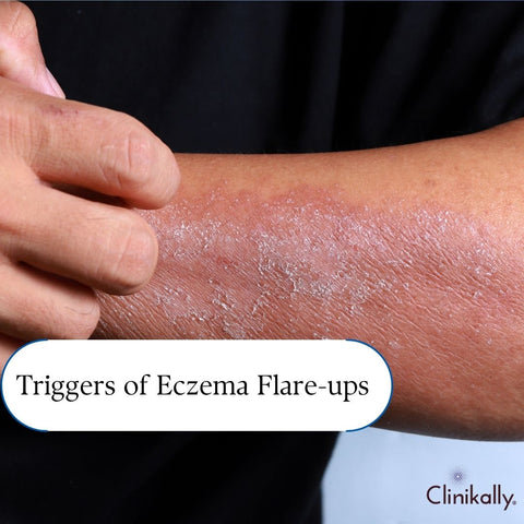 Triggers of Eczema Flare-ups