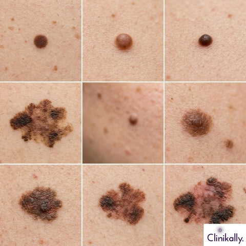 Types of Moles