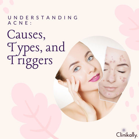 Understanding Acne: Causes, Types, and Triggers