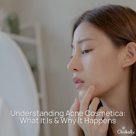 Understanding Acne Cosmetica: What It Is & Why It Happens