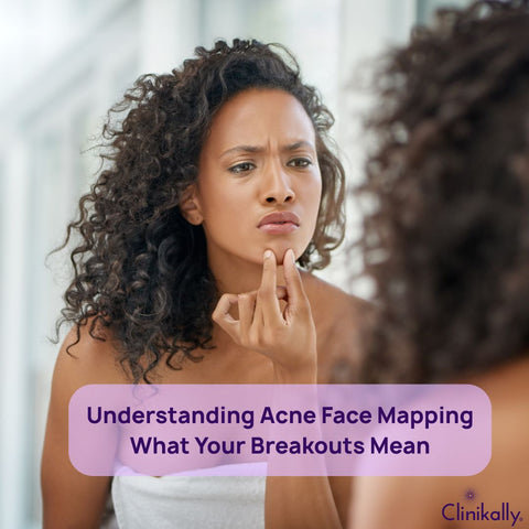 Understanding Acne Face Mapping: What Your Breakouts Mean