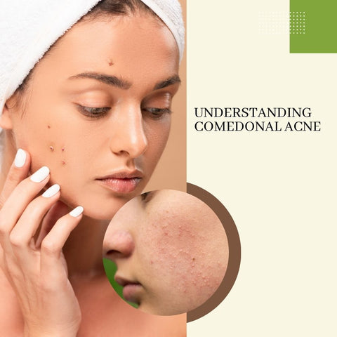 Understanding Comedonal Acne