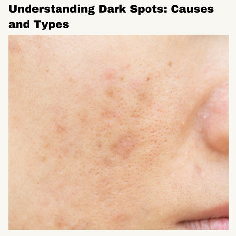 Understanding Dark Spots: Causes and Types