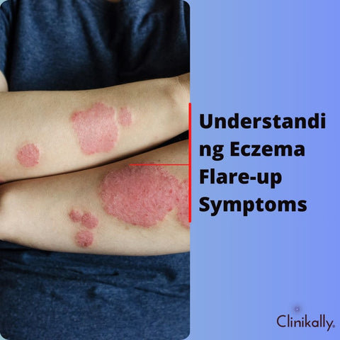 Understanding Eczema Flare-up Symptoms