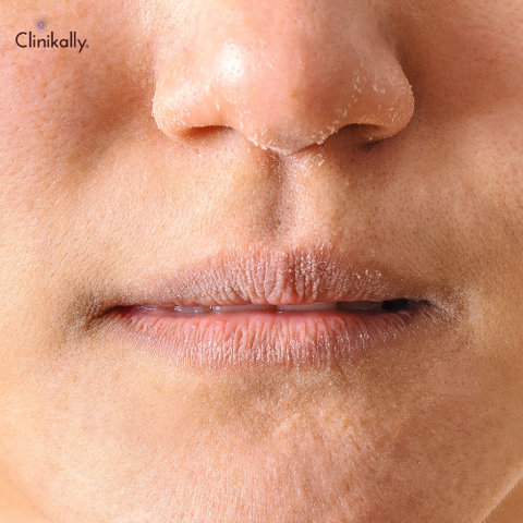 Managing Eczema on Lips: Understanding the Causes, Treatment Options, and Prevention Tips