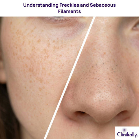 Understanding Freckles and Sebaceous Filaments