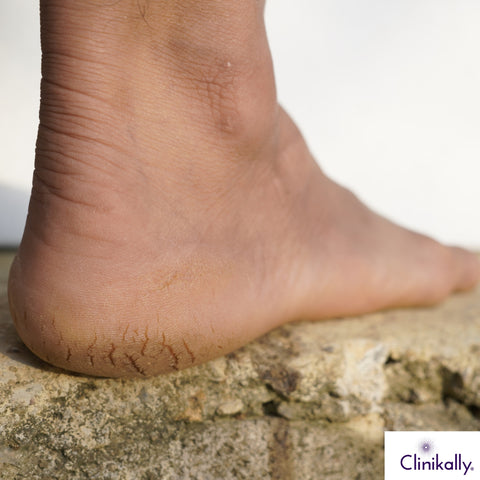 Understanding Cracked Heels & Why They Occur
