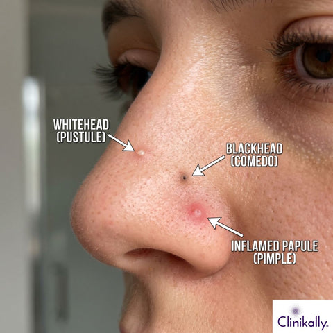 Types of nasal pimples including blackheads and whiteheads