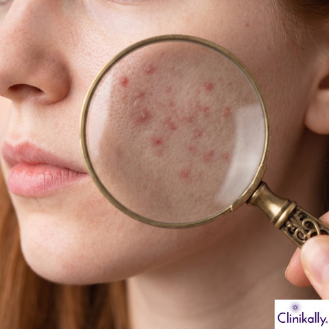 Close up of acne prone skin linked to PMOS