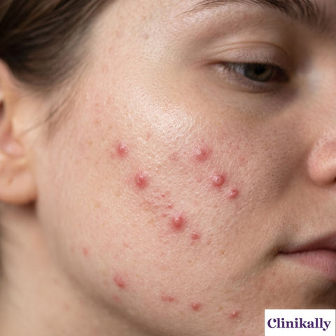 Close-up of papule acne