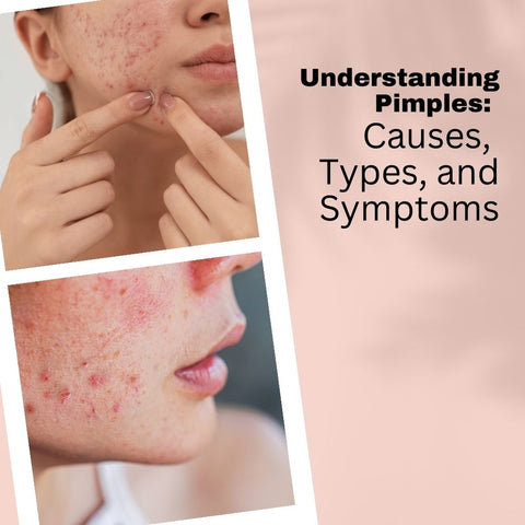Understanding Pimples: Causes, Types, and Symptoms