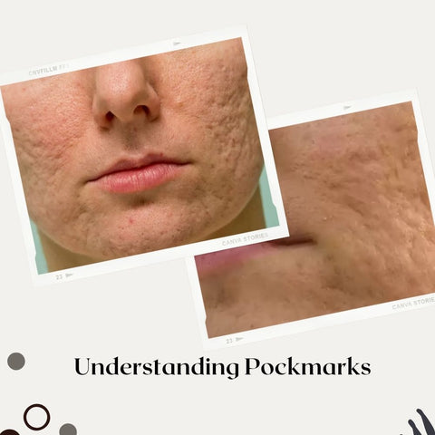 Understanding Pockmarks