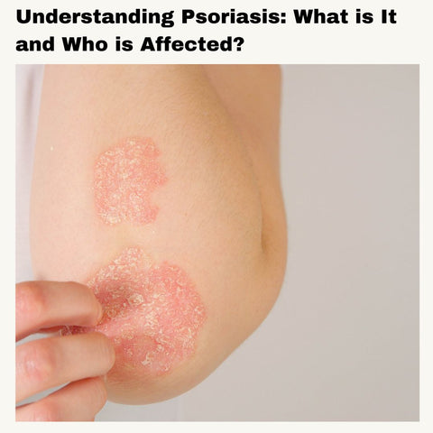 Understanding Psoriasis: What is It and Who is Affected?