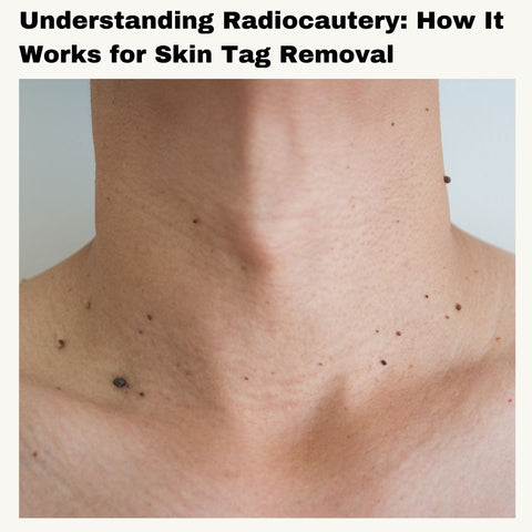 Understanding Radiocautery: How It Works for Skin Tag Removal