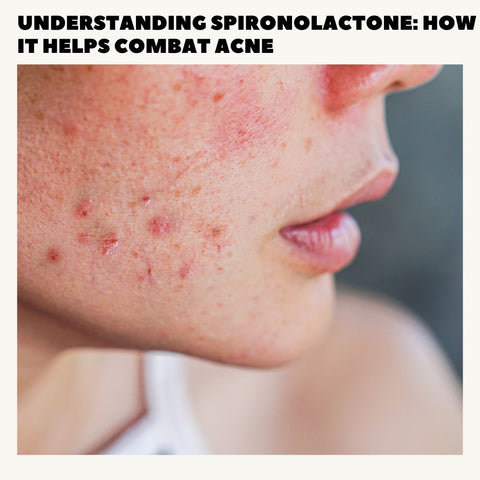 Understanding Spironolactone: How It Helps Combat Acne