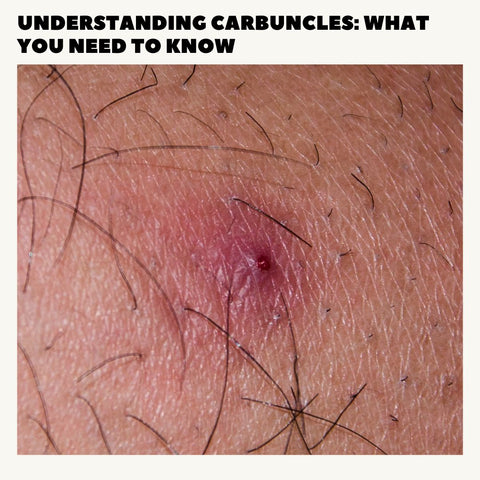 Understanding Carbuncles: What You Need to Know