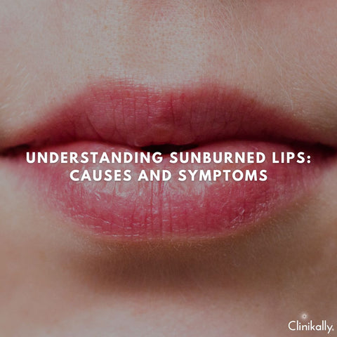 Understanding Sunburned Lips: Causes and Symptoms