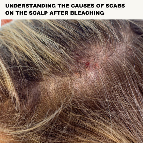 Understanding the Causes of Scabs on the Scalp After Bleaching