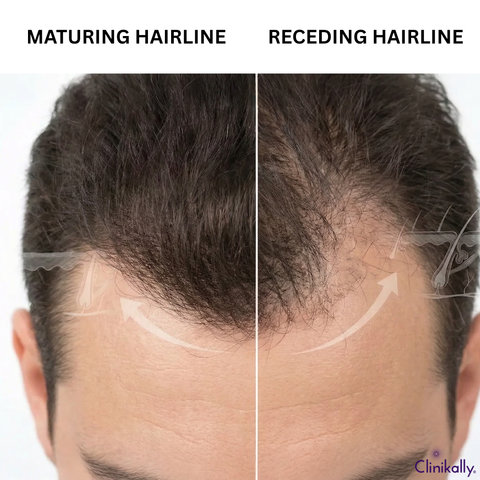 Comparison chart of maturing vs. receding hairline.