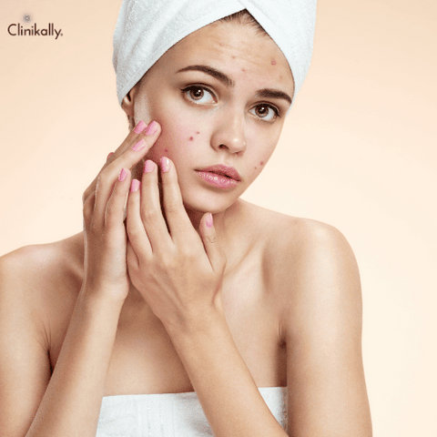 Is pimple popping for skin health?