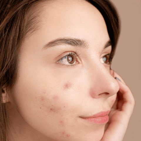Prevent pimples with healthy skincare routine