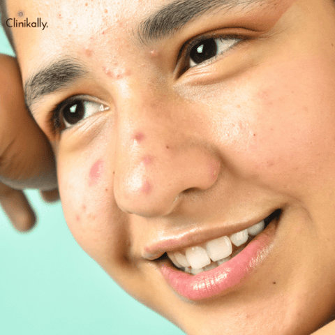 Skincare habits to treat pimples