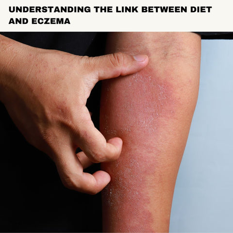 Understanding the Link Between Diet and Eczema