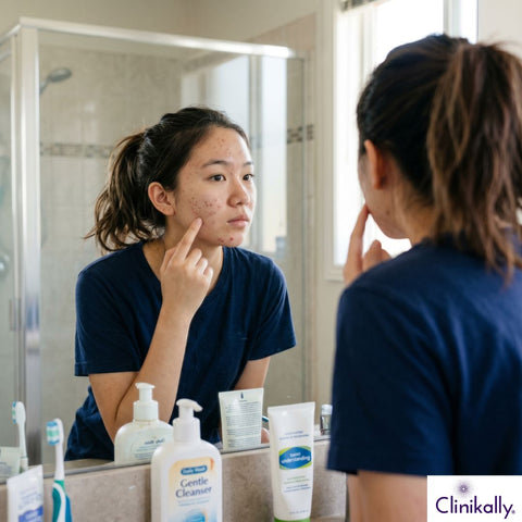 Teenager checking acne-prone skin in a bathroom mirror